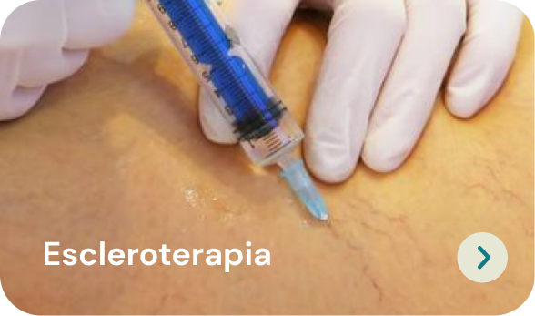 ecleroterapia playa del carmen